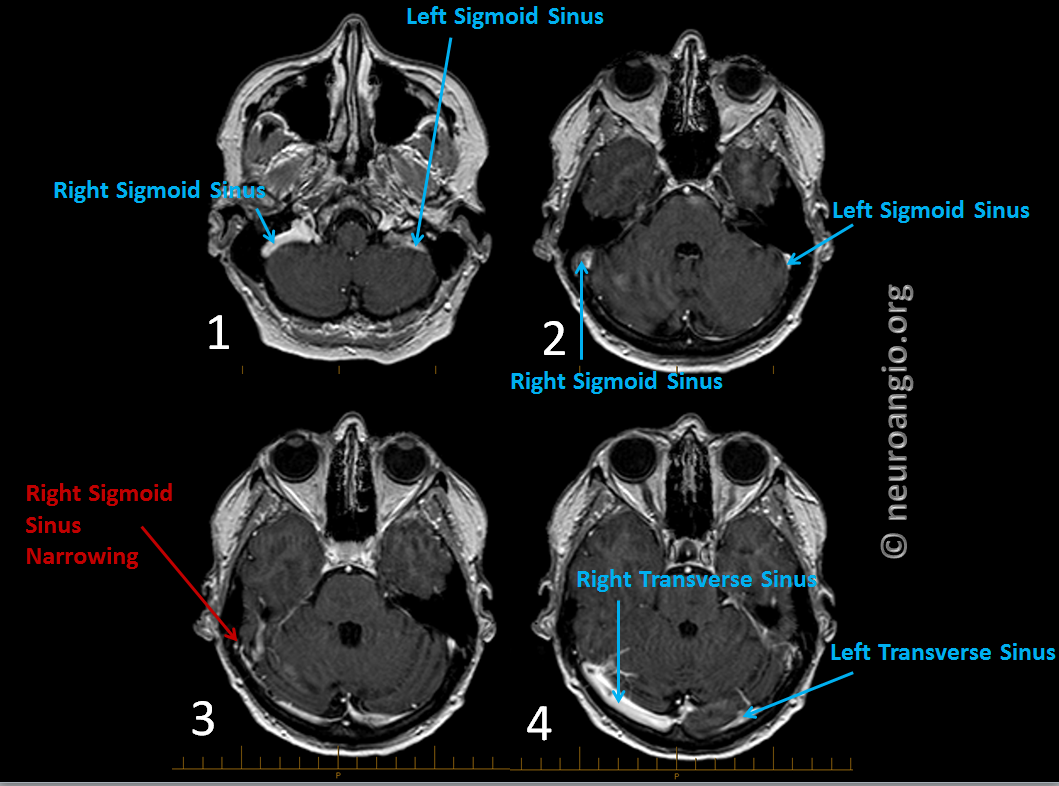 Sinus tinnitus sales